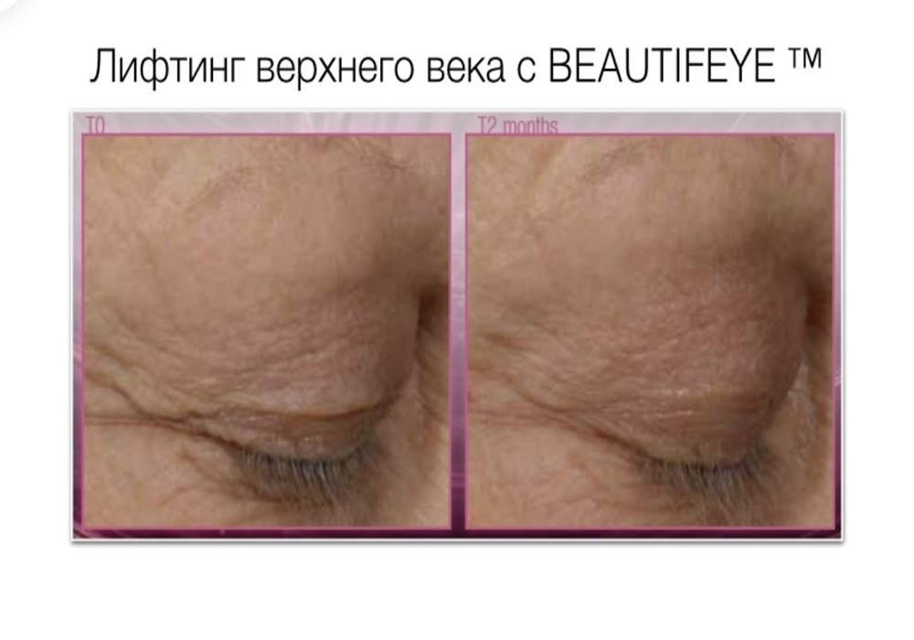 Сыворотка для области глаз